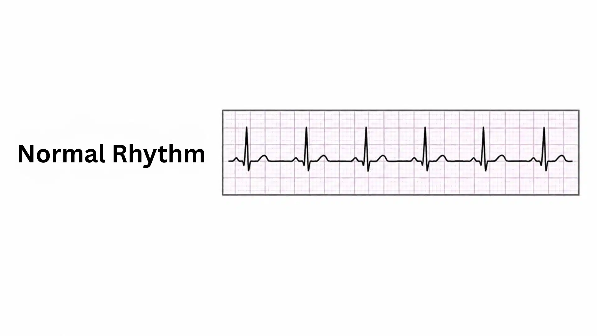 normal sinus rhythm ecg strip showing regular evenly spaced heartbeats on grid paper