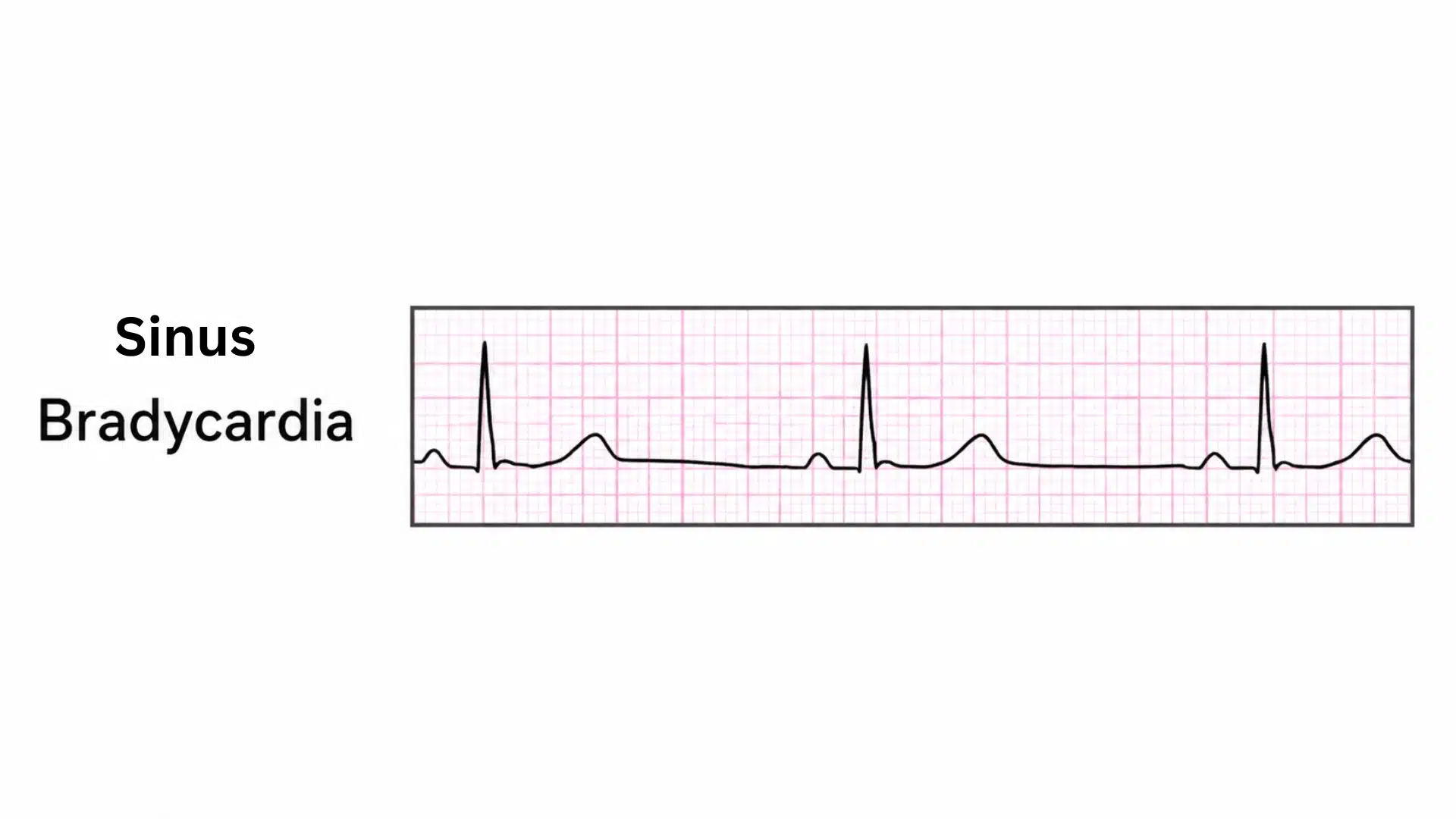 sinus bradycardia ecg strip showing a slow regular heart rhythm with widely spaced beats