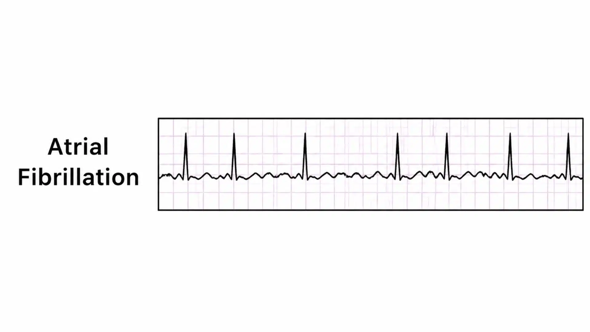 atrial fibrillation ecg strip showing an irregularly irregular rhythm with no clear p waves