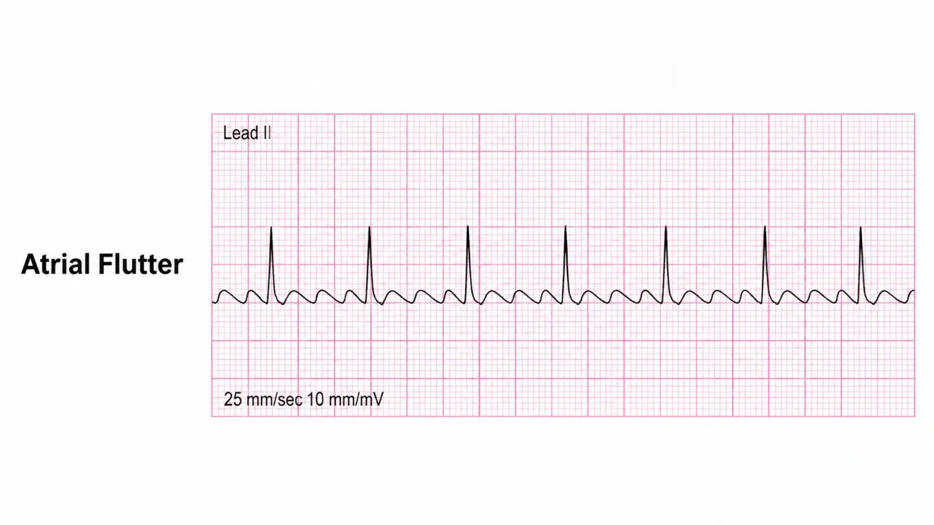 atrial flutter ecg strip showing a sawtooth pattern of flutter waves in lead ii