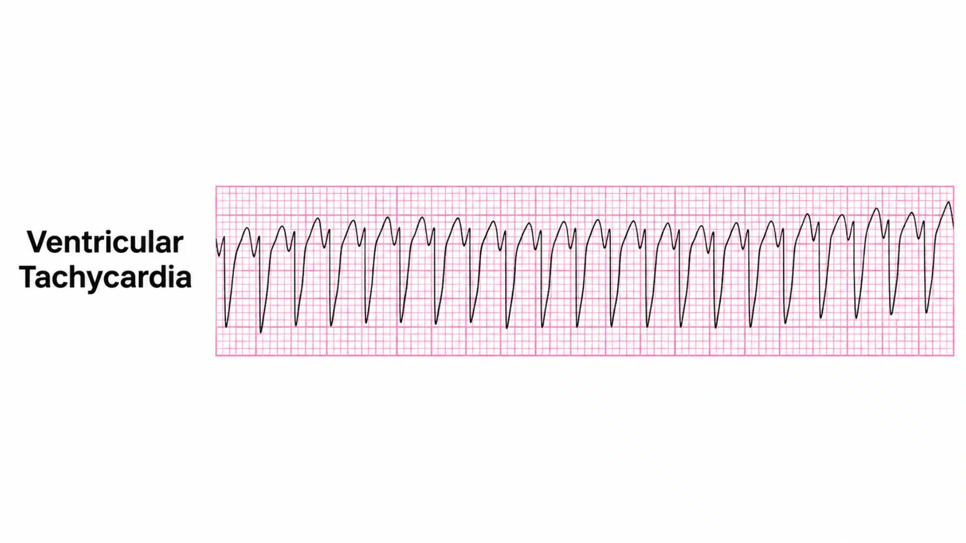 ventricular tachycardia ecg strip showing a rapid wide complex heart rhythm