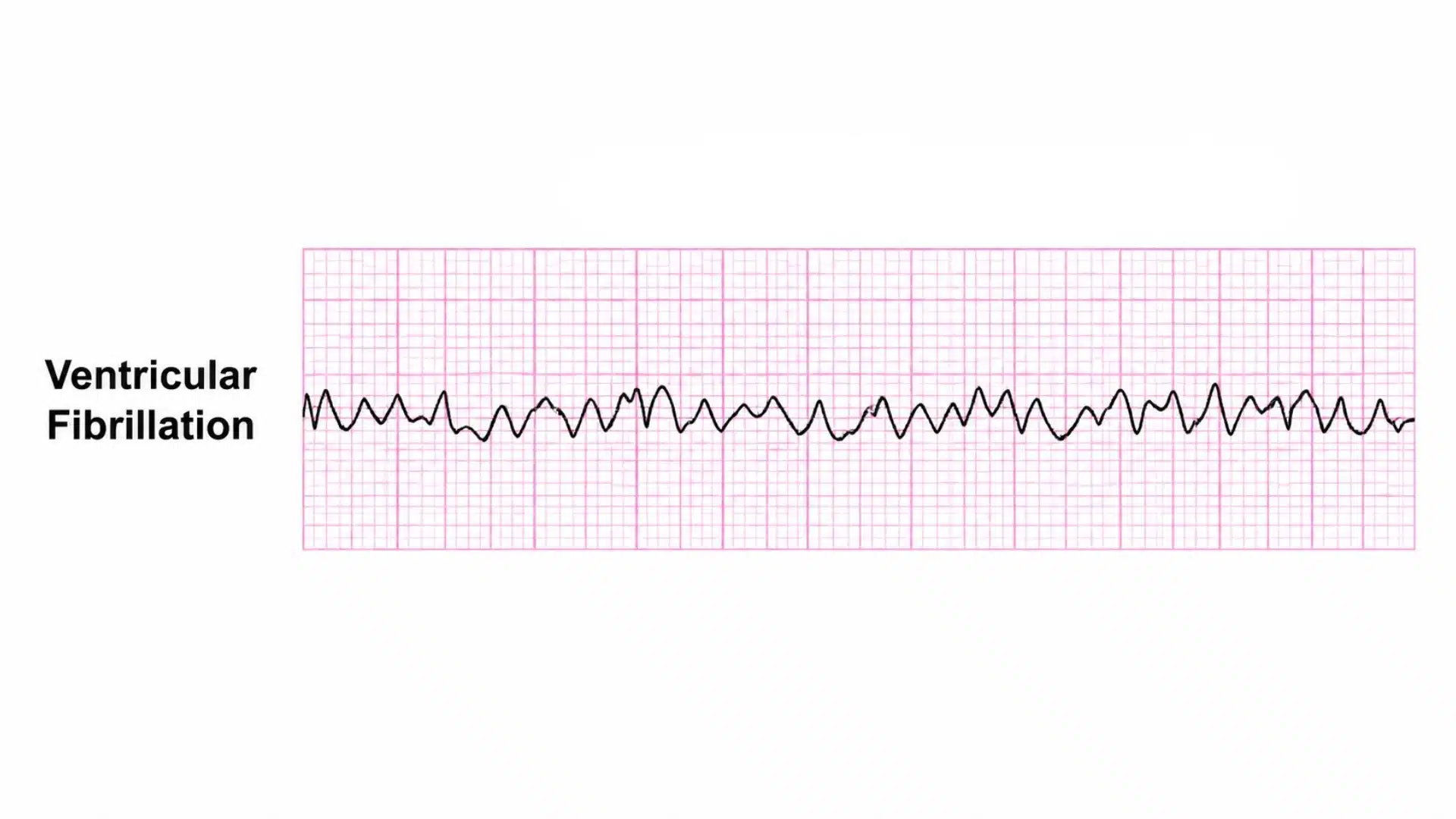 ventricular fibrillation ecg strip showing chaotic disorganized electrical activity