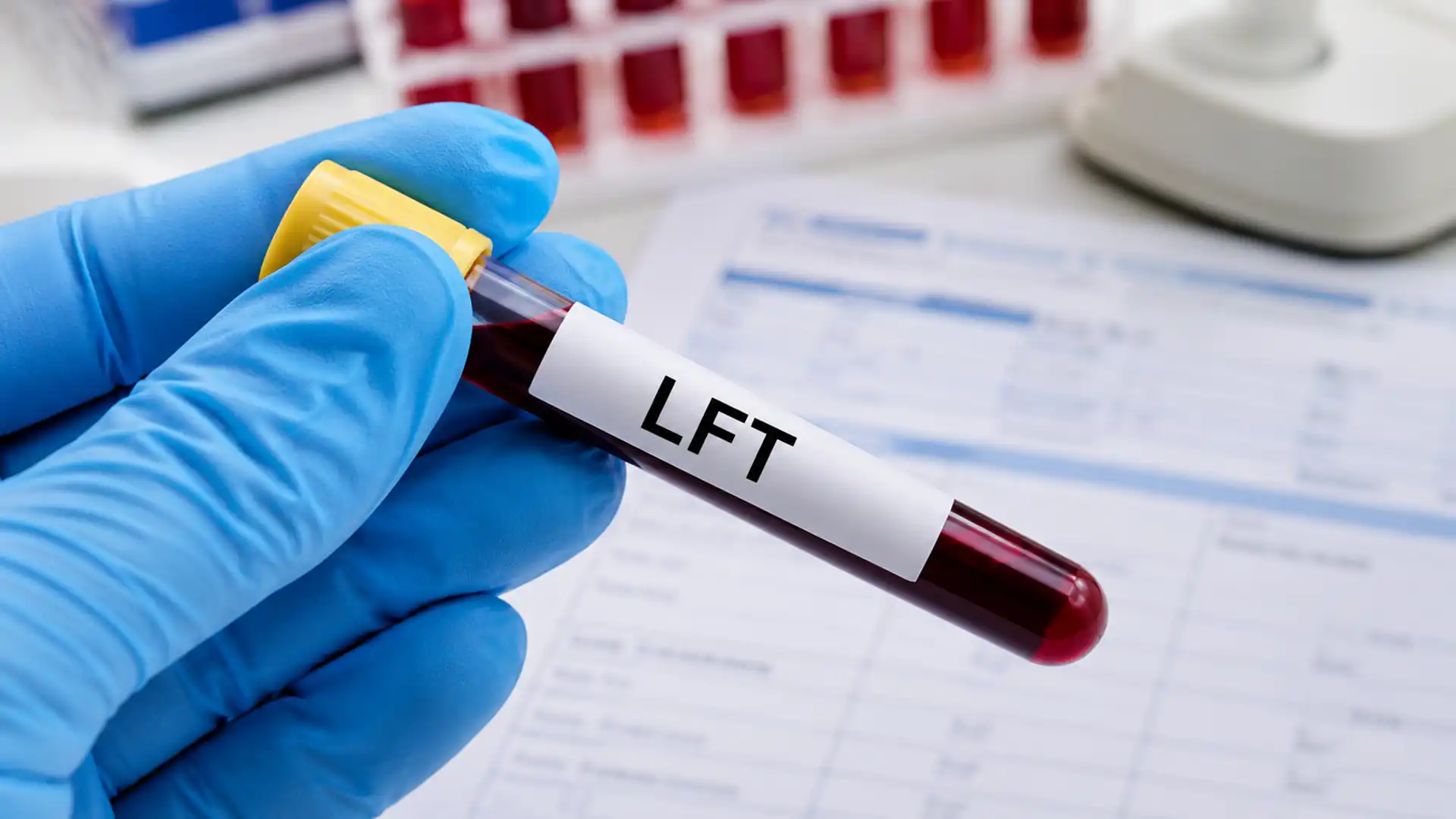gloved hand holding an lft blood sample tube with laboratory test paperwork visible in the background