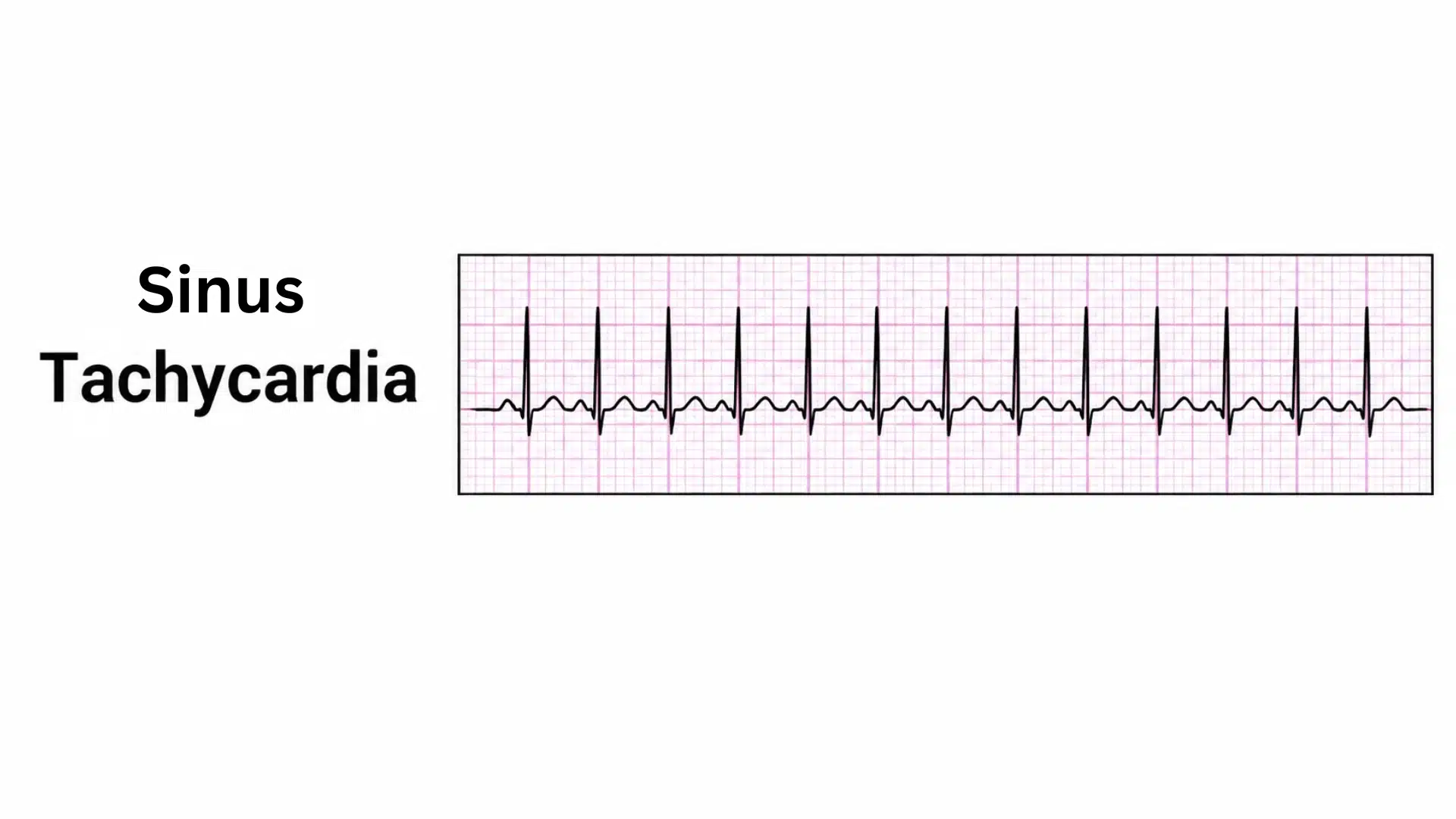 sinus tachycardia ecg strip showing a fast regular heart rhythm with closely spaced beats